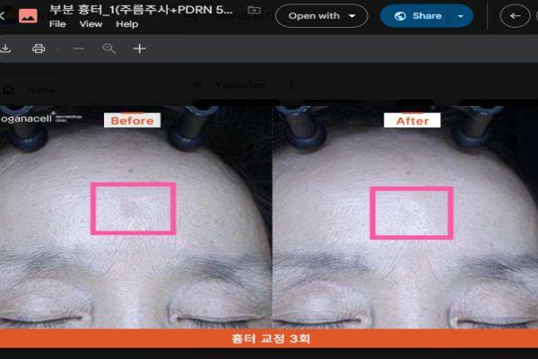 痘坑凹疤怎么修复?点阵激光、飞梭、皮下分离、填充——一次把方法讲清楚 1 痘坑凹疤怎么修复?点阵激光、飞梭、皮下分离、填充——一次把方法讲清楚