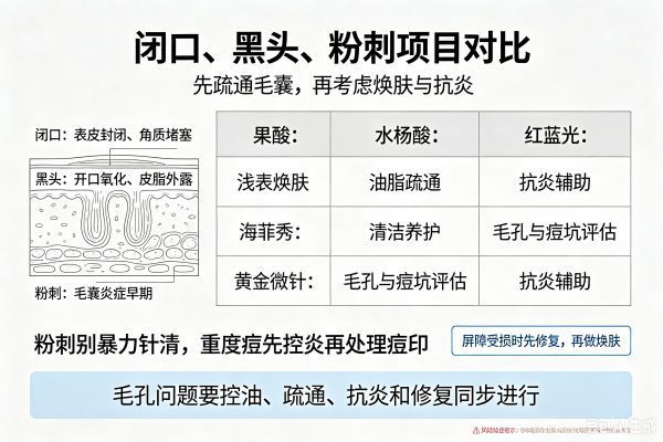 粉刺与闭口医美项目选择图：三种粉刺类型特征对比，果酸换肤/海菲秀/微针/蓝雷射等项目价格与适用情况对照。