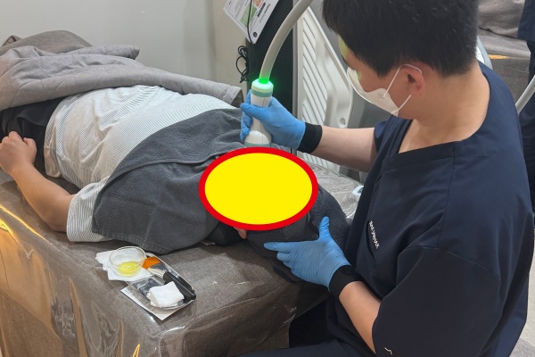 ONDA溶脂能维持多久？副作用、风险、注意事项全解析