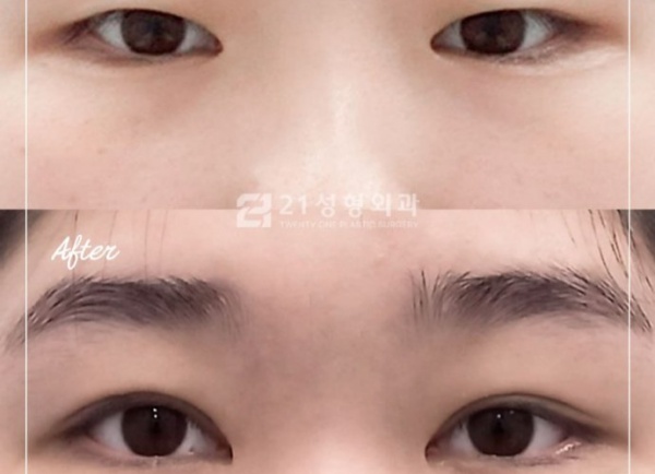 双眼皮+提眉一起做效果好吗?眉眼综合设计,1+1>2的变美逻辑